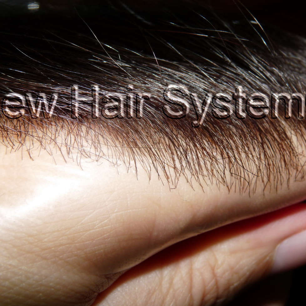 Injected Skin hairpiece